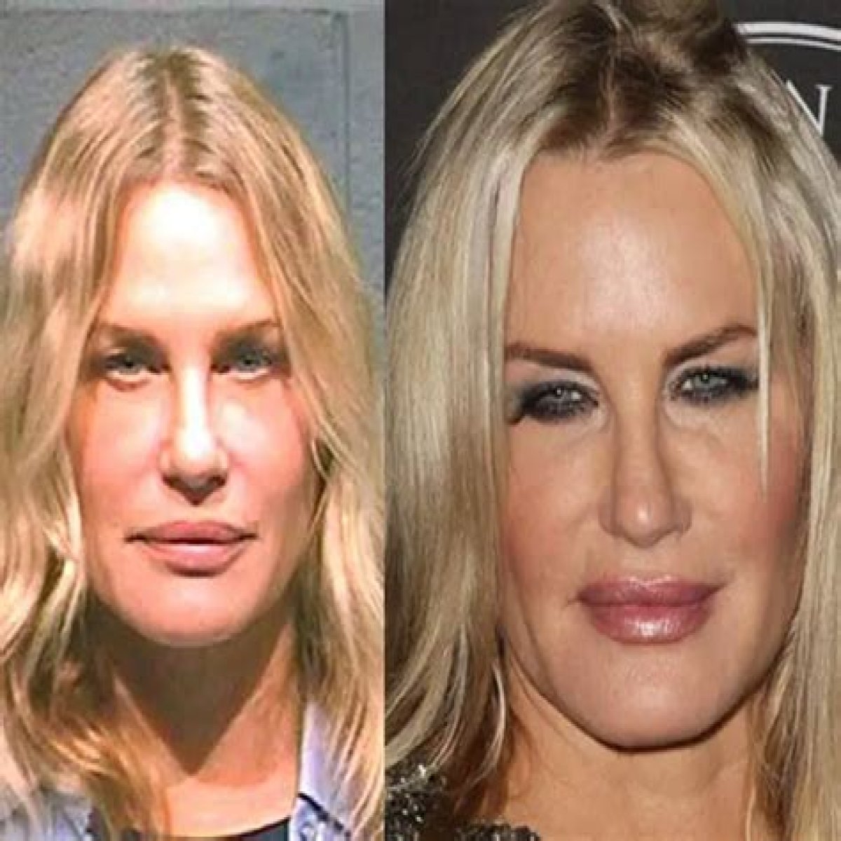 Daryl Hannah Plastic Surgery Before and After Botox Injections